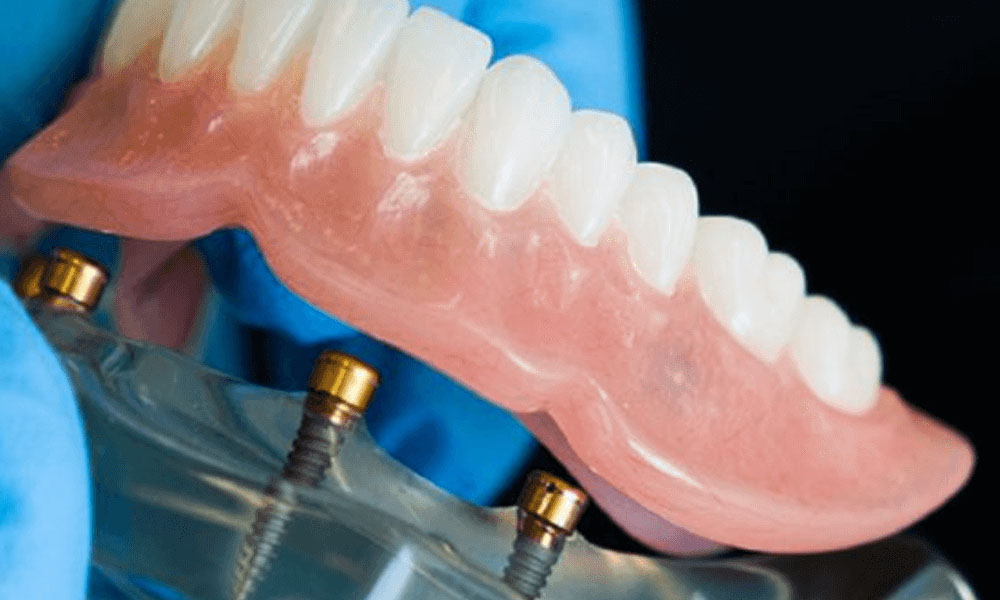 Implant Overdentures: Sydney Denture Clinic's Modern Dental Solutions