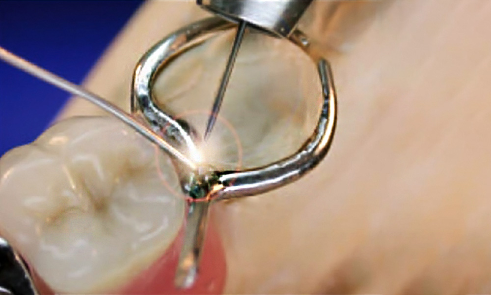 Dental laser welding image